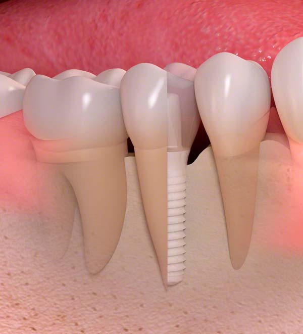 Lebensqualität mit Implantaten